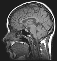 TCGA-LGG: Brain Tumors