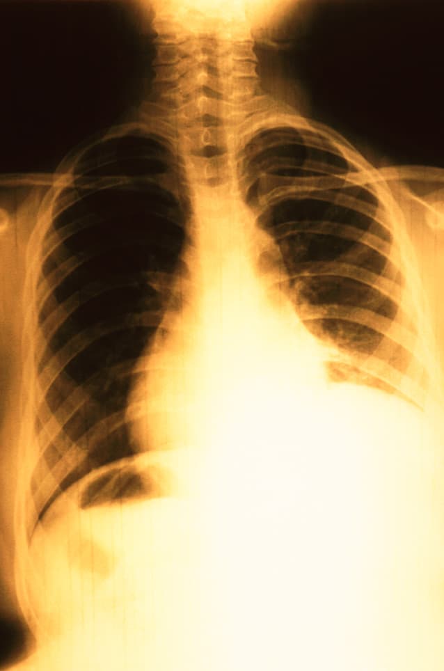 CheXpert: Chest X-Rays